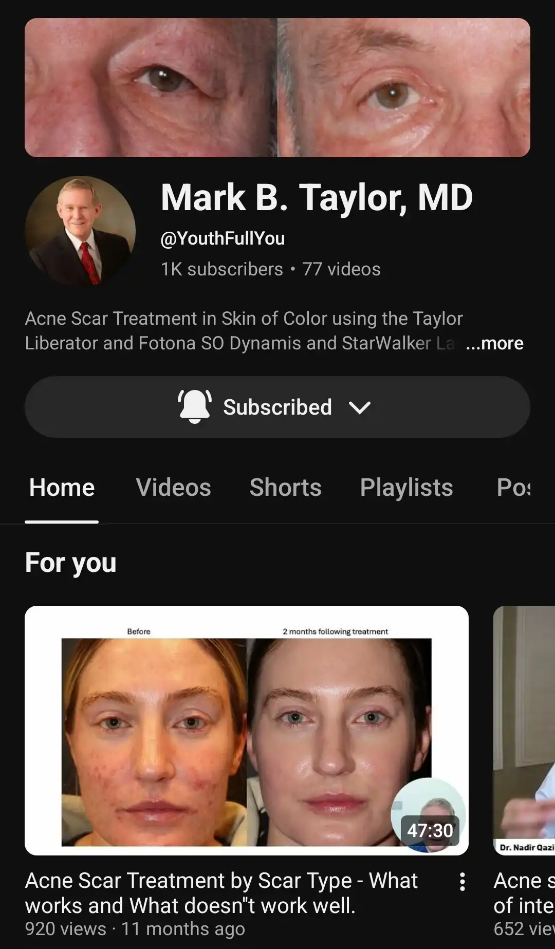 multimodal acne treatment